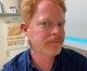 Jesse Tyler Ferguson is ‘gonna be just fine’ after having ‘a bit of skin cancer’ removed Jesse Tyler Ferguson is ‘gonna be just fine’ after having ‘a bit of skin cancer’ removed